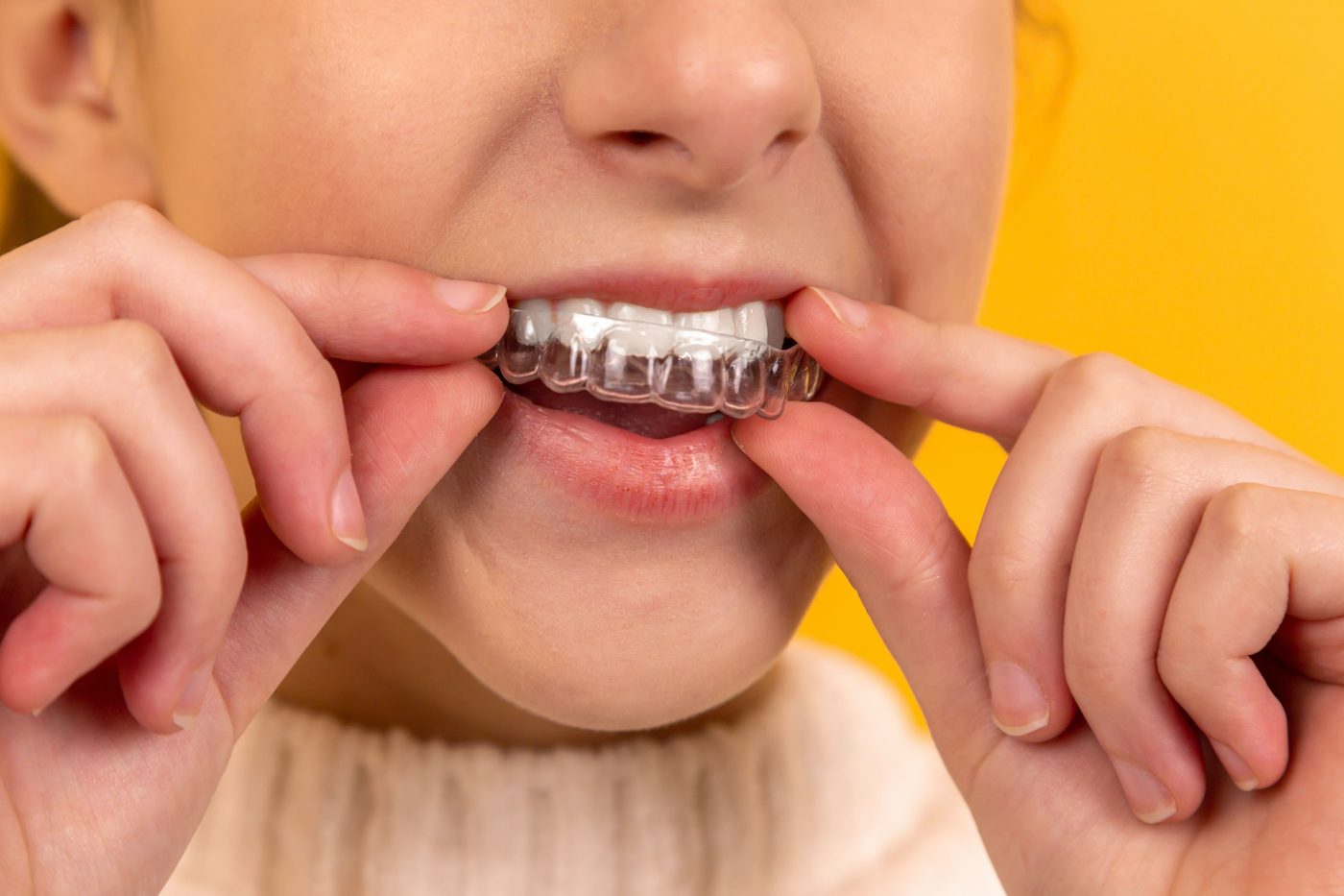 Invisalign Cost in Malaysia 2025: What to Expect Before Starting Treatment